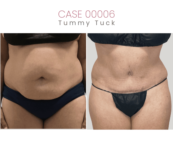 TUMMY-TUCK-1A