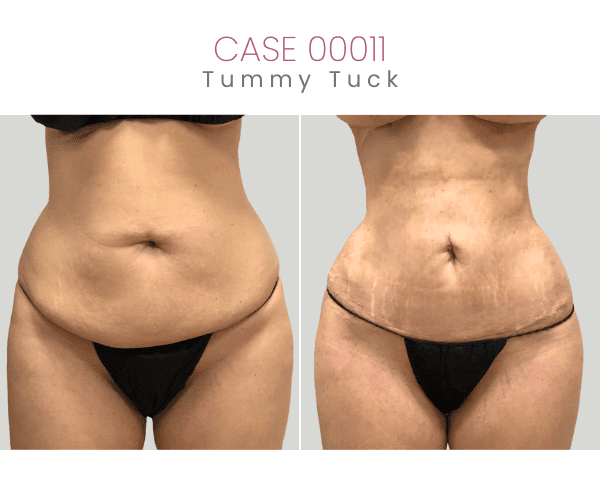 TUMMY-TUCK-6A