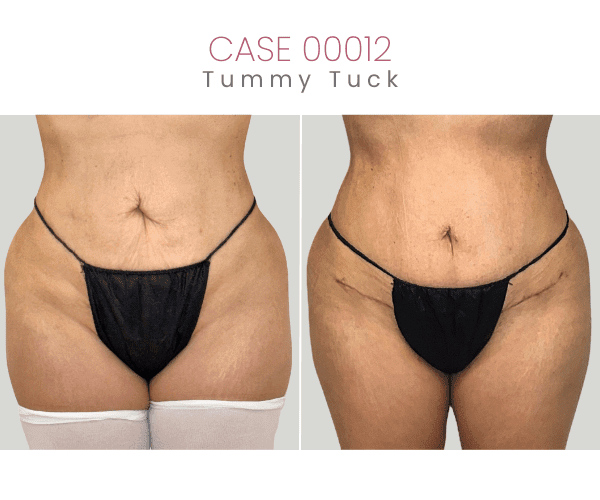 TUMMY-TUCK-7A
