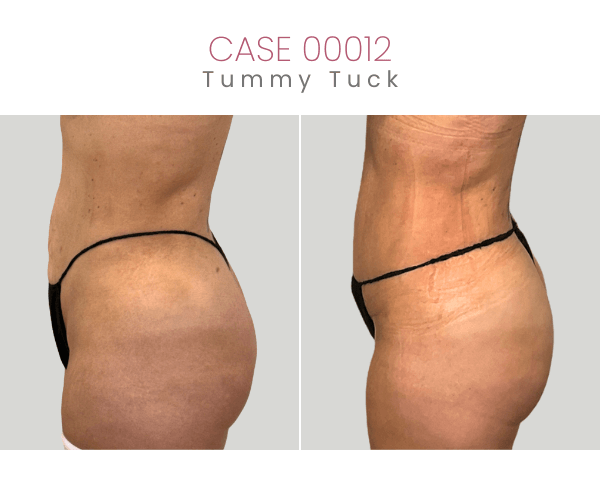 TUMMY-TUCK-7B