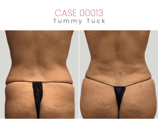 TUMMY-TUCK-8B
