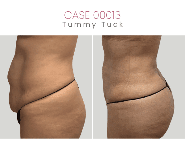 TUMMY-TUCK-8C